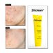 Очищающий гель для проблемной кожи с акне Acnemy ZITCLEAN Purifying Cleansing Gel 150 мл AC43199 фото 2