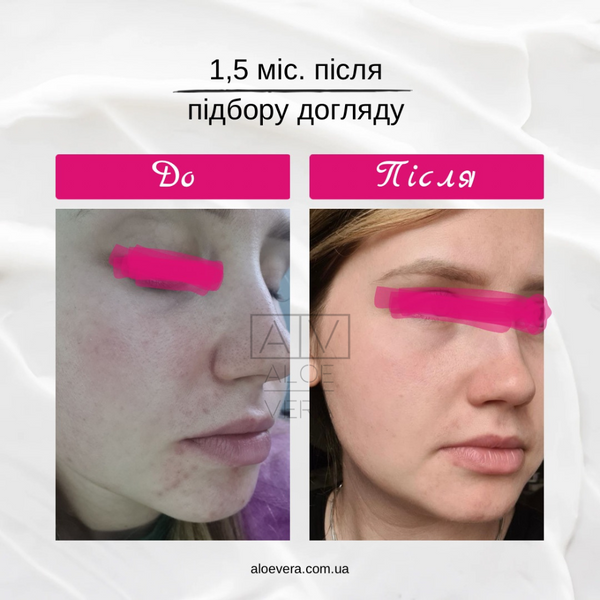 Консультація по підбору догляду за обличчям в ALOE VERA з підтримкою 2 місяці CONSULTATION-2 фото