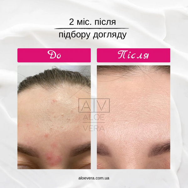 Консультація по підбору догляду за обличчям в ALOE VERA з підтримкою 2 місяці CONSULTATION-2 фото