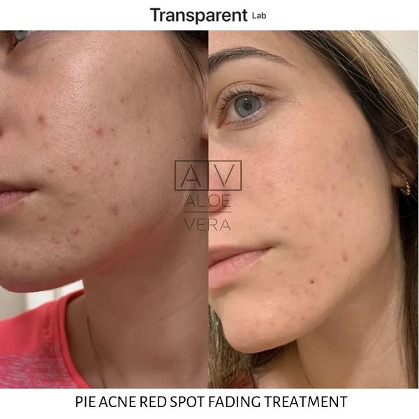 Засіб для лікування постзапальної еритеми Transparent Lab PIE Acne Red Spot Fading Treatment 30 мл TL43208 фото