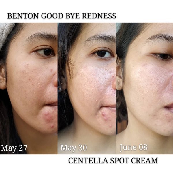 Крем для точкового застосування з центелою азіатською Benton Goodbye Redness Centella Spot Cream 15 г BN0563 фото